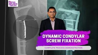 Dynamic Condylar Screw Fixation Procedure [upl. by Ereynihc]