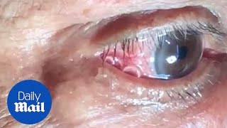 GRAPHIC Moment 15cm long worm is removed from mans eye [upl. by Pears637]