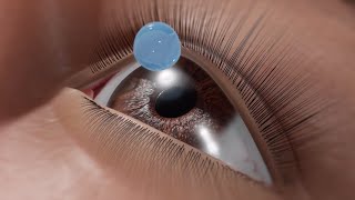 Cirugía ocular LASIK Animación 3D [upl. by Nashbar]