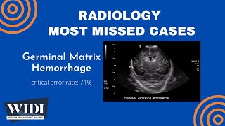 Most Missed Cases Germinal Matrix Hemorrhage [upl. by Dreddy]