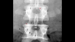 Radiological Anatomy of the Lumbar Spine Xray MRI amp CT Covered [upl. by Thibaut]