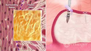 Minimally Invasive Fibroid Ablation – Dr Mitch Dizon [upl. by Shanie]