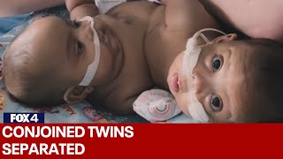 FULL VIDEO Conjoined twins separated at Cook Childrens Medical Center [upl. by Riccardo147]