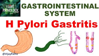 H Pylori Gastritis  Epidemiology Pathogenesis Clinical features Sequelae amp Treatment [upl. by Ag384]