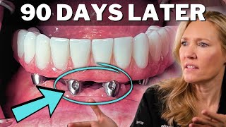 All On 4 REGRETS  Final PERMANENT Teeth In 24 Hours PROBLEMS [upl. by Kelam]