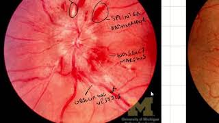 Papilloedema Fundoscopic Appearances [upl. by Tessy102]