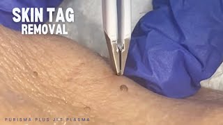 Skin Tag Removal with Purisma Plus Jet Plasma [upl. by Ulysses]