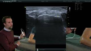 Elleboog  Common extensor tendon dwars  E14  echografie [upl. by Starlin]