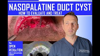 NASOPALATINE DUCT CYST REMOVAL [upl. by Palladin713]