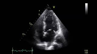 Initial echocardiography showing akinesia of lateral midseptal and apical walls [upl. by Pascoe]