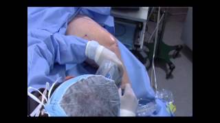 Endovenous Radiofrequency Ablation Training Video [upl. by Appleby]