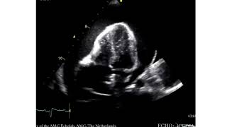 Cardiac Tamponade  Large Pericardial Effusion [upl. by Liddle]