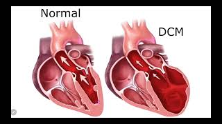 IM Cardiology 16 Cardiomyopathies Dilated cardiomyopathy DCM [upl. by Alil770]