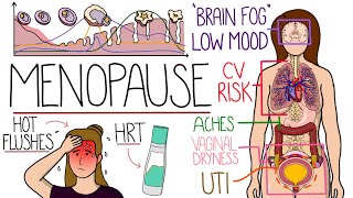 Menopause Explained Clearly Includes HRT amp Perimenopause [upl. by Nylatsyrk]