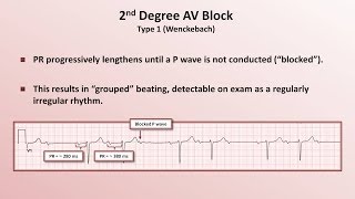 Intro to EKG Interpretation  AV Block [upl. by Gard292]