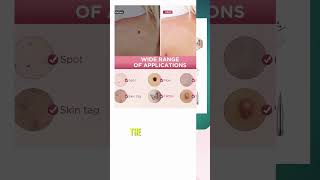 Best Skin Tag Removal Kit Reviews  Best Reviews Blog 2023 [upl. by Kenley]