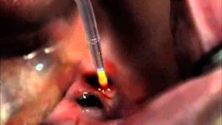 Treating PeriImplant Mucositis [upl. by Estey329]