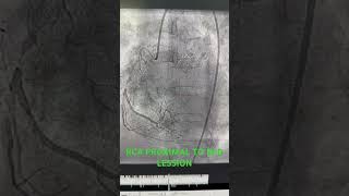 RCA PROXIMAL TO MID LESSION  PRIMARY PCI TO RCA shorts [upl. by Doris]