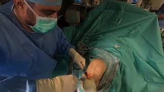 Operatie ligament  ACL surgery live [upl. by Jacquetta]