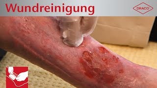 Wundreinigung Debridement bei chronischer Wunde  Verbandswechsel  DRACO [upl. by Everrs]