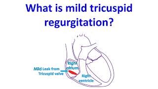 What is mild tricuspid regurgitation [upl. by Llezom858]