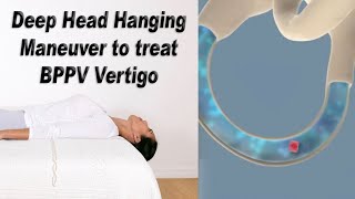 Deep Head Hanging Maneuver to Treat BPPV Vertigo [upl. by Cleveland]