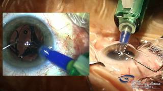 Implante de una Lente Intraocular Multifocal MPLUS [upl. by Sonnnie]