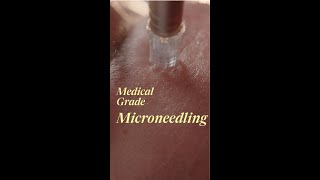 Medical Grade Microneedling [upl. by Montano215]