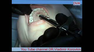 Infiltration Anesthesia for treatment 1112 teeth [upl. by Hein52]