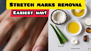 Stretch Marks Removal How to remove Stretch Marks stretch marks stretchmarks howto howtoremove [upl. by Na488]