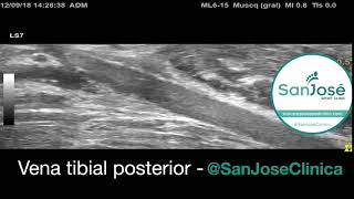 ECOGRAFIA VENA TIBIAL POSTERIOR [upl. by Just897]