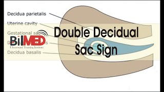 DOUBLE DECIDUAL SAC SIGN  Vlogs  BilMed USG Training [upl. by Yasnil]