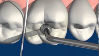 Silicone p Modelos  VOCO  Dental Speed [upl. by Forest]