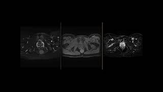 Tailgut cystretrorectal hamartoma [upl. by Rabma]