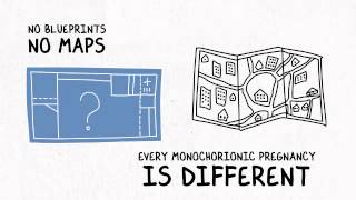 Monochorionic Twins Presentation [upl. by Niela]