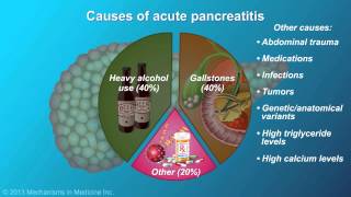 Acute Pancreatitis [upl. by Honna]