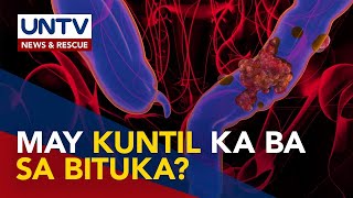 Pagkakaroon ng kuntil o polyps sa bituka posibleng mauwi sa colon cancer – expert [upl. by Ennahtur612]