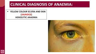 Hematology  1  U5L7  Clinical diagnosis of anaemia [upl. by Ahsekyt]