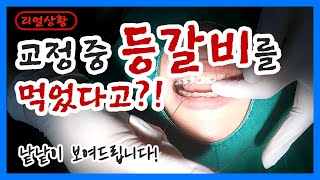 치아교정 장치 브라켓 떨어짐이 치아교정 기간에 영향을 준다고 브라켓 탈락 재부착 영상 [upl. by Euell]