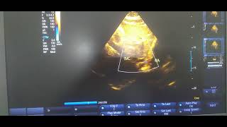 Subcostal view showing IVC with normal dimension and inspiratory collapse [upl. by Joslyn]