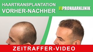 Haartransplantation vorher nachher Tibor Zeitraffervideo  PROHAARKLINIK [upl. by Nord]