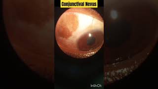 Conjunctival Nevus  Optometry with ShahideyesConjunctivalNevus eyes optometry [upl. by Hekker]