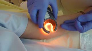 Vein Access with Veinlite LEDX [upl. by Michelle]