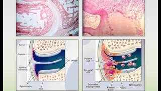 Rheumatoid Arthritis and Systemic Lupus Erythematosus Webinar [upl. by Drolyag]