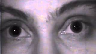 Nystagmus eye movement recording 1 [upl. by Winfred411]