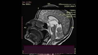 Microsurgical Resection of Foramen magnum meningioma [upl. by Gensmer]