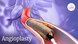 How is Angioplasty Done  Radial Access Procedure  PostTreatment Care After Angioplasty [upl. by Yelik429]