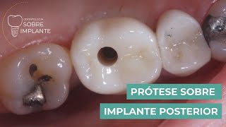 Como Confeccionar uma Prótese Unitária sobre Implante  Passo a Passo [upl. by Egan]