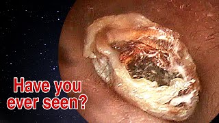 BIGGEST Ear Wax Difficult Removal  EP1  Doctor Anh [upl. by Ennoid]