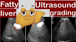 Fatty liver Ultrasound grading [upl. by Miharba230]